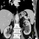 Adenoma of adrenal gland: CT - Computed tomography